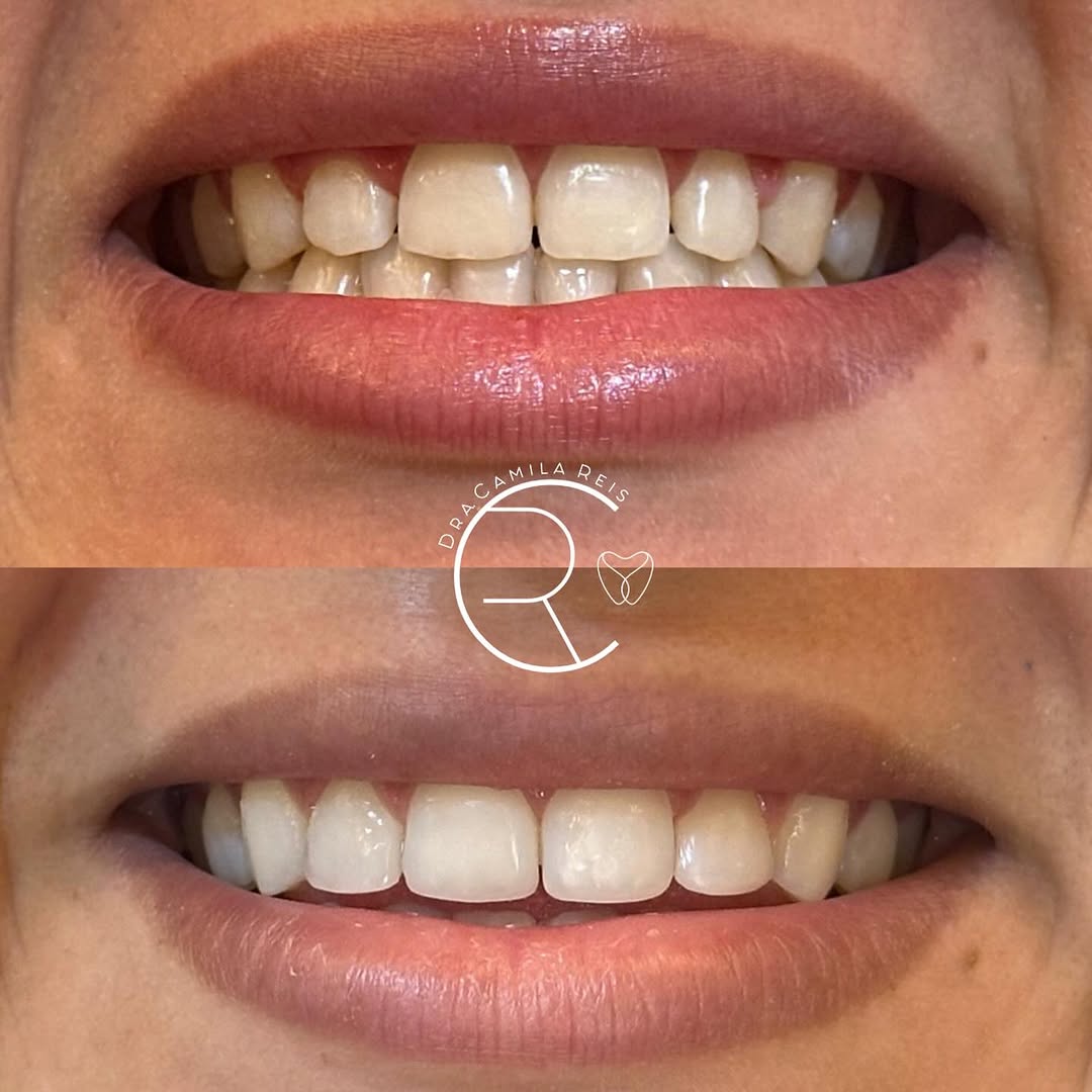 Antes e depois - Dra. Camila Reis