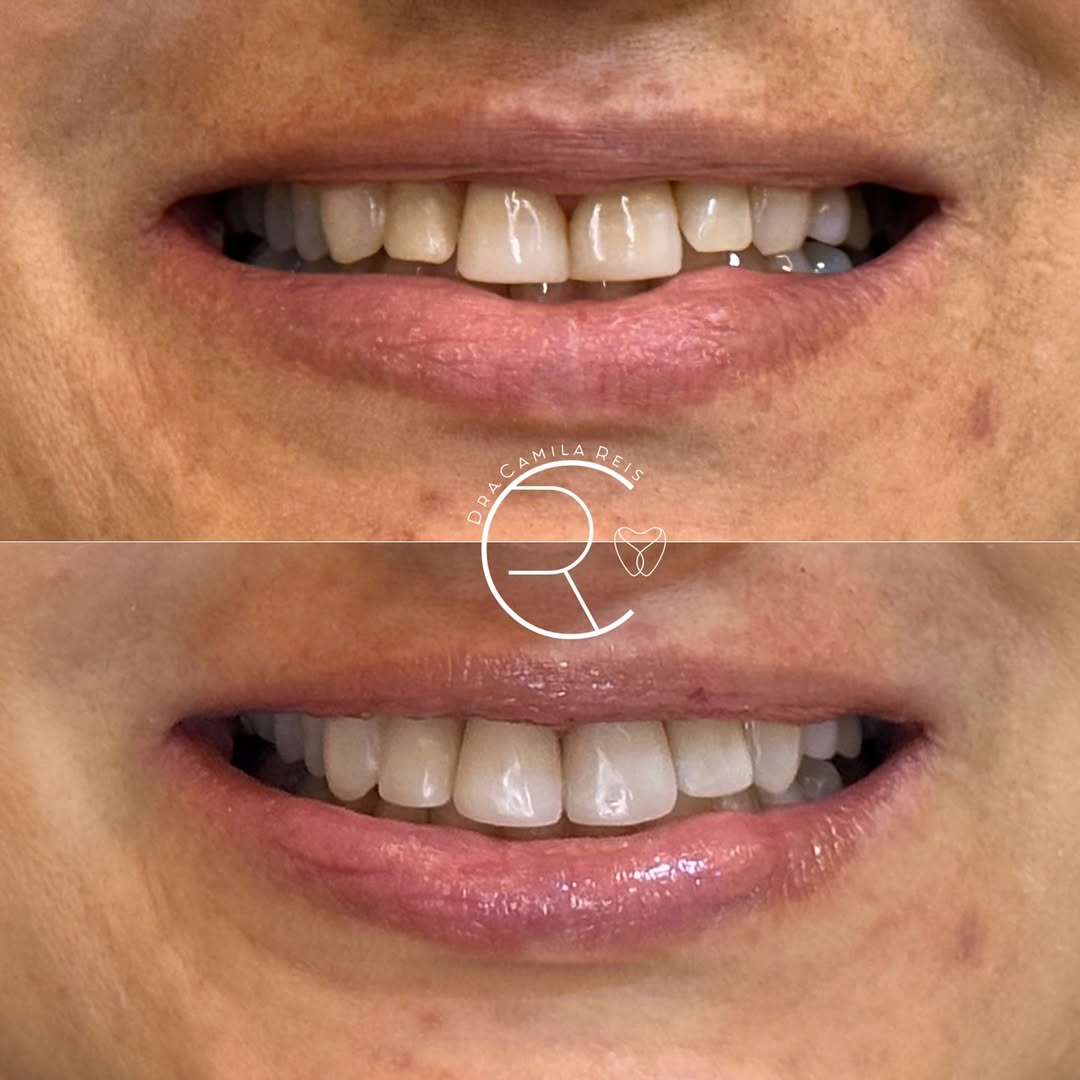 Antes e depois - Dra. Camila Reis