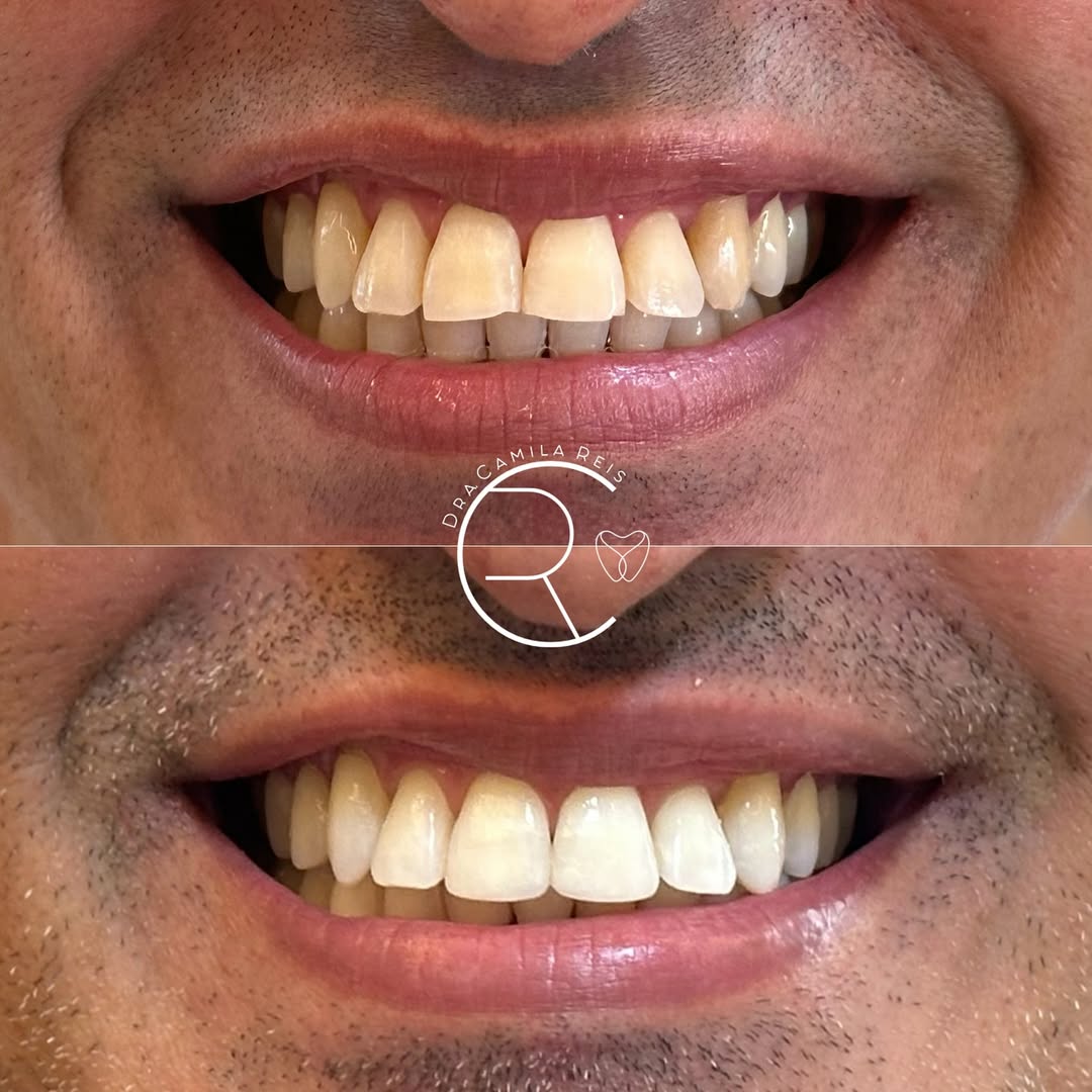 Antes e depois - Dra. Camila Reis